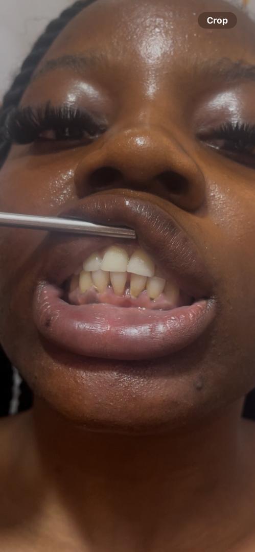 Teeth scaling and polishing treatment close-up