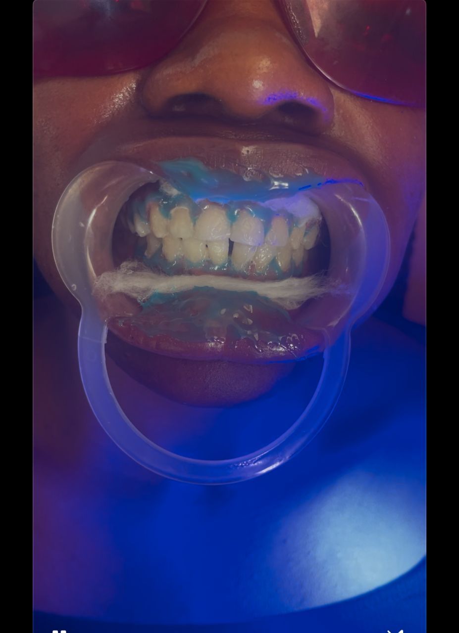 Professional teeth whitening procedure at Stherline Beauty Home